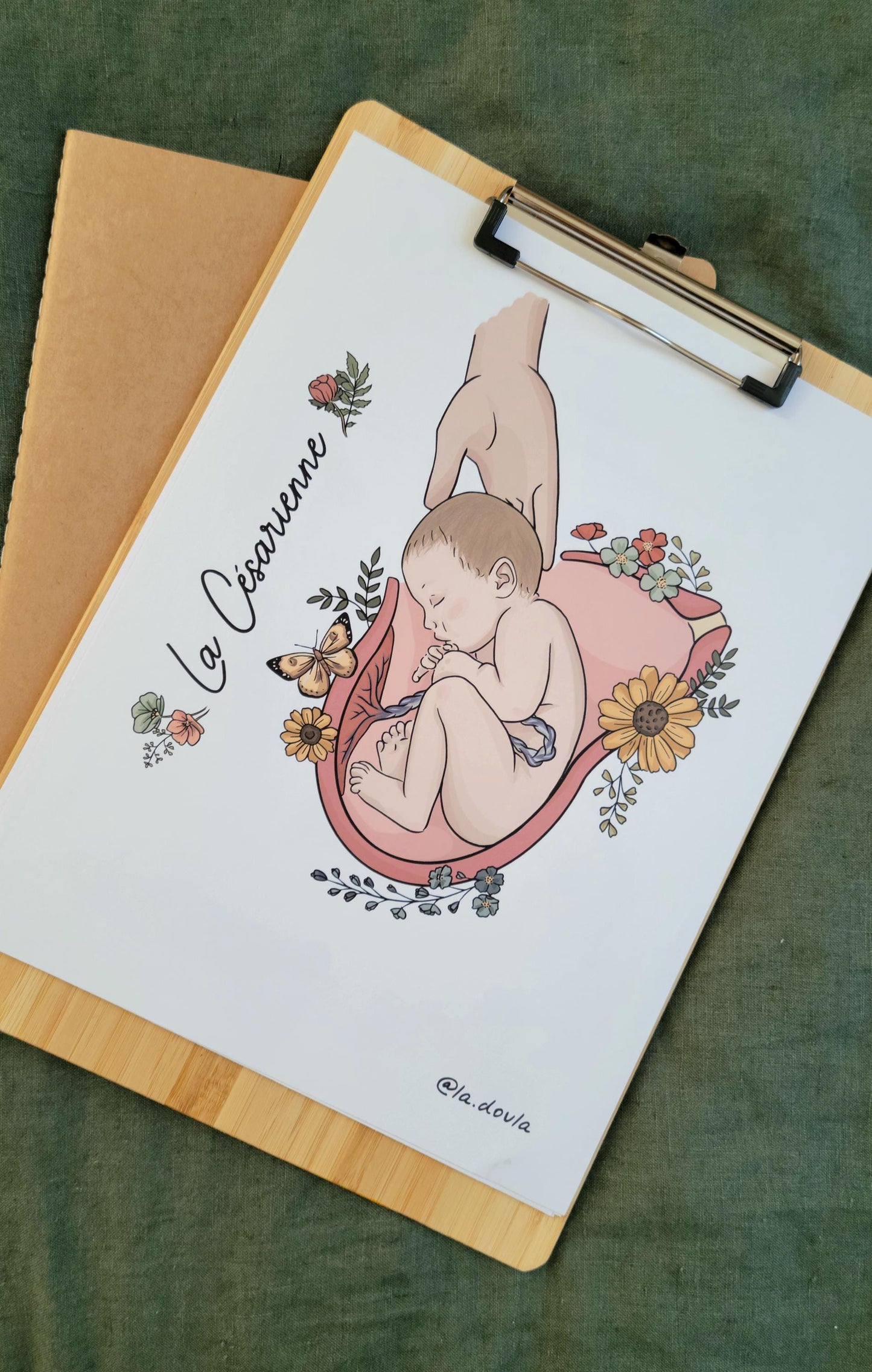 Cesarean section (color version)