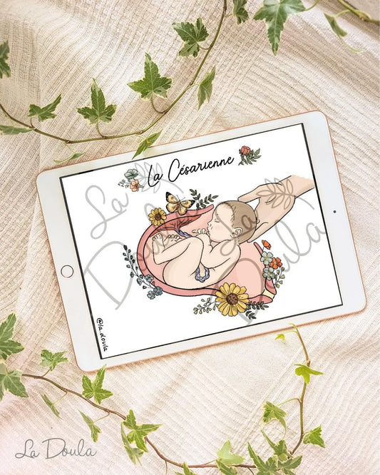 Cesarean section (color version)